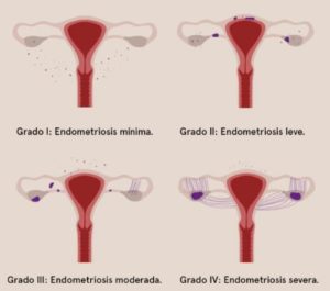 Grados endometriosis